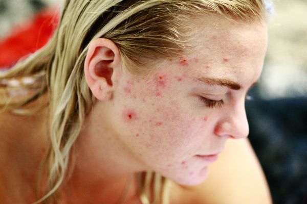 sintomas de SOMP Mujer con acné marcado uno de los síntomas de SOMP