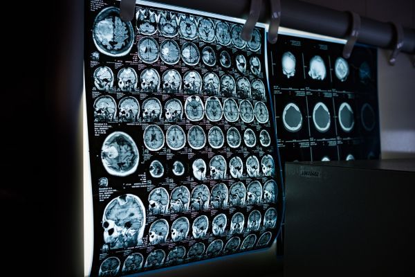  Varios cortes de resonancia magnética cerebral en un panel iluminado, ilustrando daños estructurales y neuroinflamación.